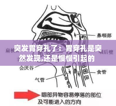 突发胃穿孔了：胃穿孔是突然发现,还是慢慢引起的 